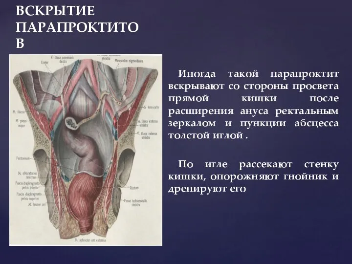 ВСКРЫТИЕ ПАРАПРОКТИТОВ Иногда такой парапроктит вскрывают со стороны просвета прямой кишки