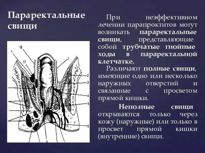 Параректальные свищи При неэффективном лечении парапроктитов могут возникать параректальные свищи, представляющие