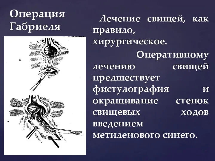 Операция Габриеля Лечение свищей, как правило, хирургическое. Оперативному лечению свищей предшествует