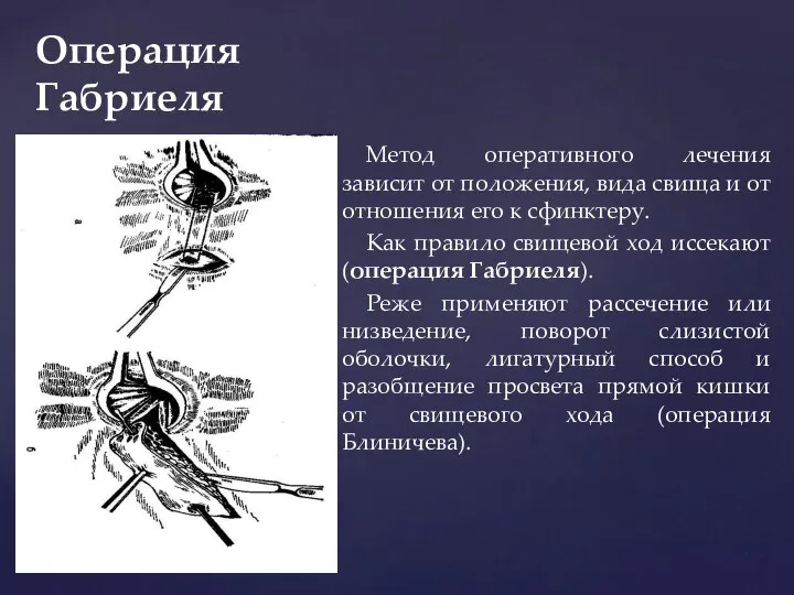 Операция Габриеля Метод оперативного лечения зависит от положения, вида свища и