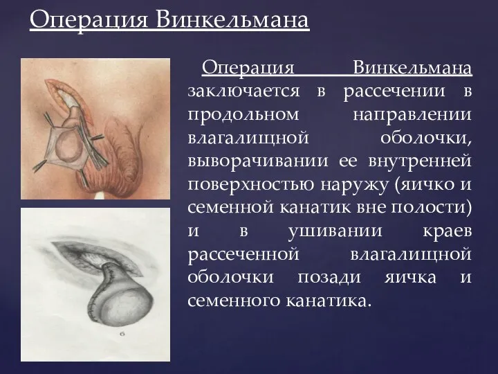 Операция Винкельмана Операция Винкельмана заключается в рассечении в продольном направлении влагалищной