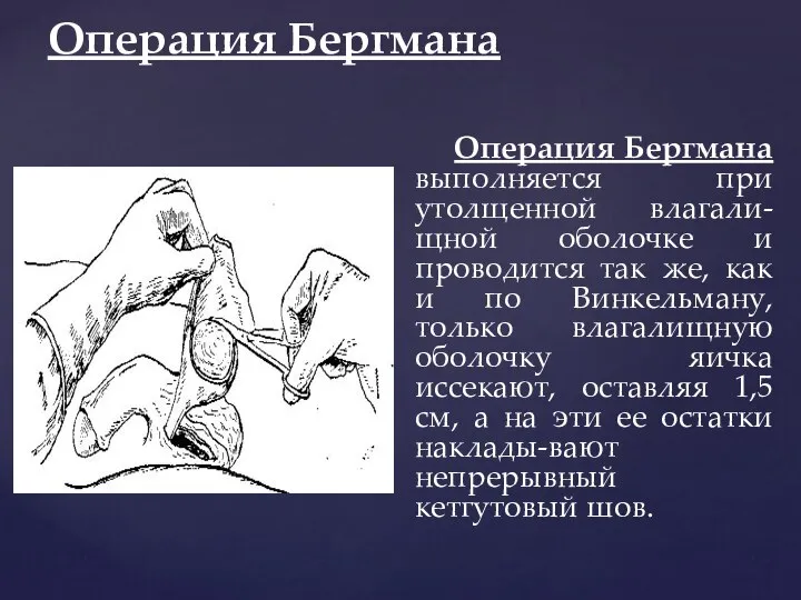 Операция Бергмана Операция Бергмана выполняется при утолщенной влагали-щной оболочке и проводится