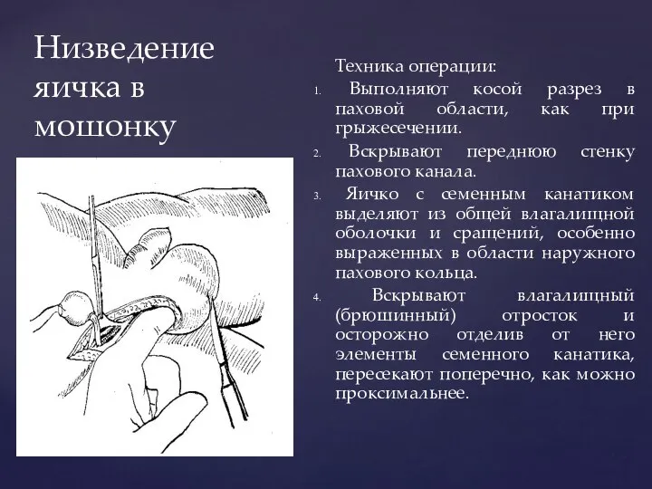 Низведение яичка в мошонку Техника операции: Выполняют косой разрез в паховой