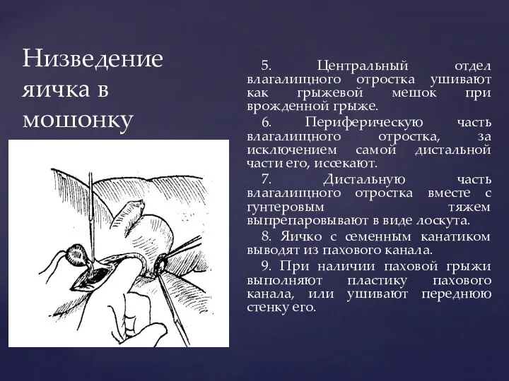 Низведение яичка в мошонку 5. Центральный отдел влагалищного отростка ушивают как