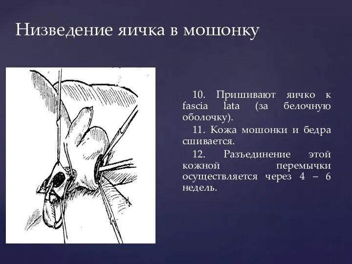 Низведение яичка в мошонку 10. Пришивают яичко к fascia lata (за