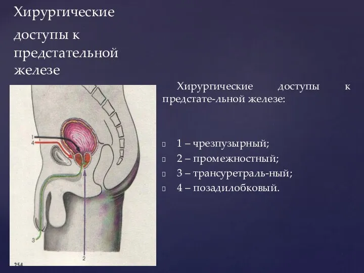 Хирургические доступы к предстательной железе Хирургические доступы к предстате-льной железе: 1