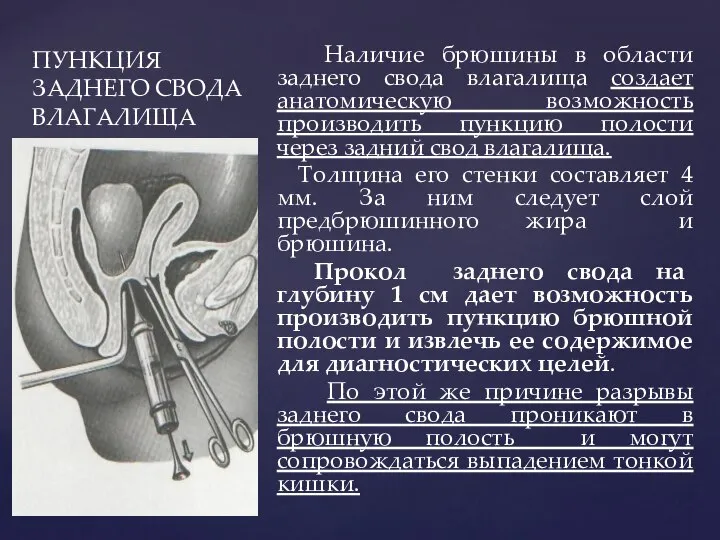 ПУНКЦИЯ ЗАДНЕГО СВОДА ВЛАГАЛИЩА Наличие брюшины в области заднего свода влагалища