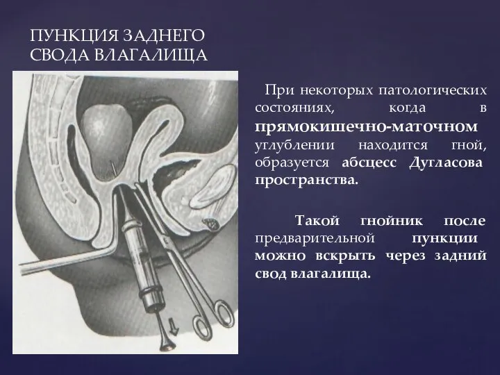 ПУНКЦИЯ ЗАДНЕГО СВОДА ВЛАГАЛИЩА При некоторых патологических состояниях, когда в прямокишечно-маточном