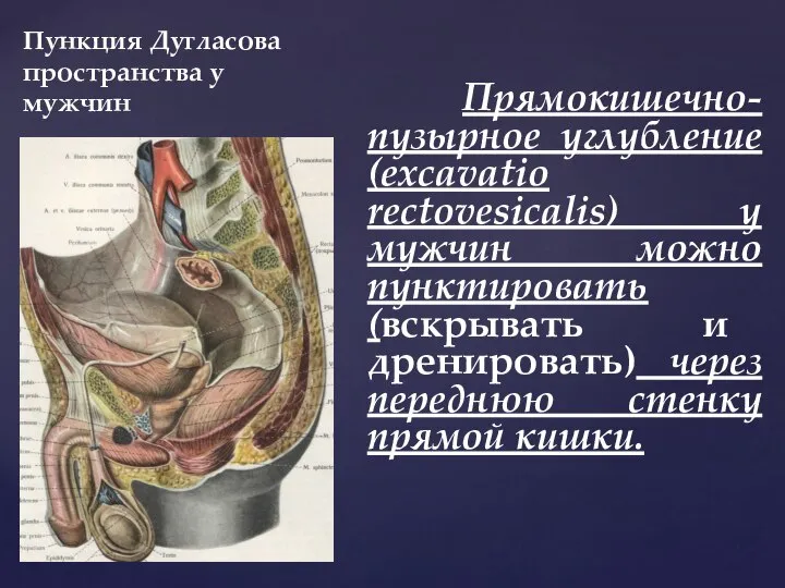 Пункция Дугласова пространства у мужчин Прямокишечно-пузырное углубление (excavatio rectovesicalis) у мужчин