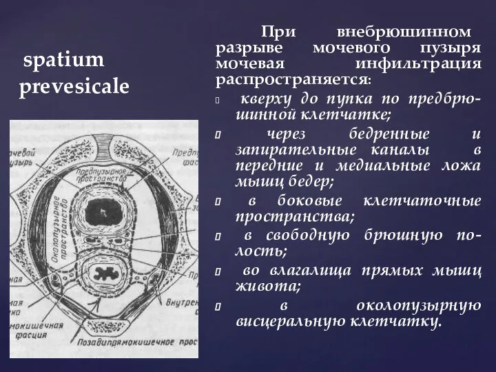 spatium prevesicale При внебрюшинном разрыве мочевого пузыря мочевая инфильтрация распространяется: кверху