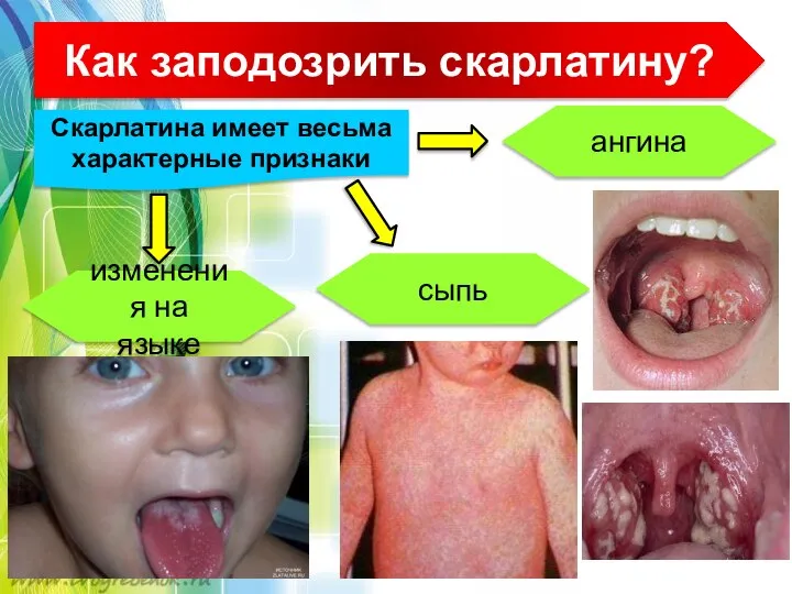 Как заподозрить скарлатину? Скарлатина имеет весьма характерные признаки ангина сыпь изменения на языке