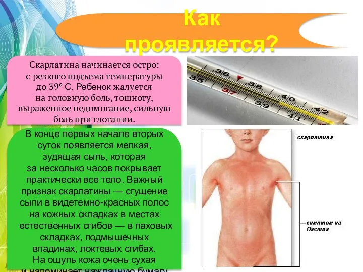 Как проявляется? Скарлатина начинается остро: с резкого подъема температуры до 39º