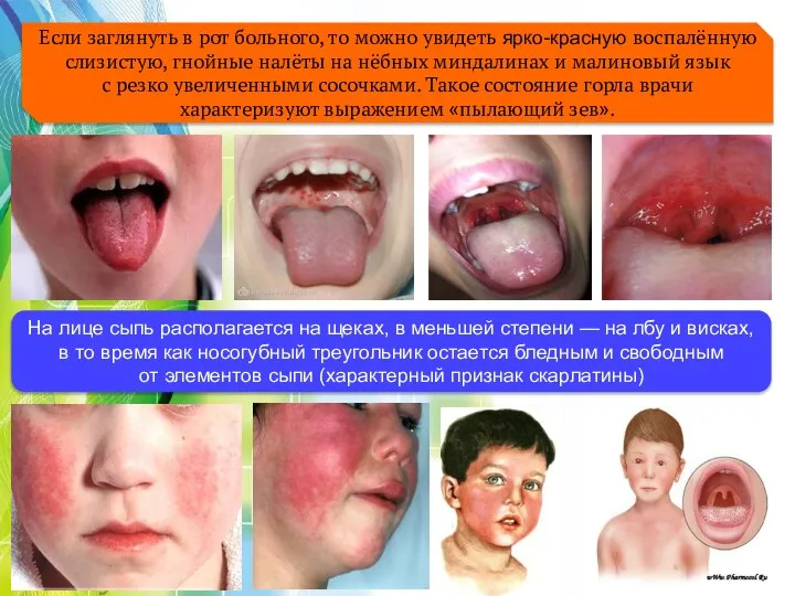 Если заглянуть в рот больного, то можно увидеть ярко-красную воспалённую слизистую,
