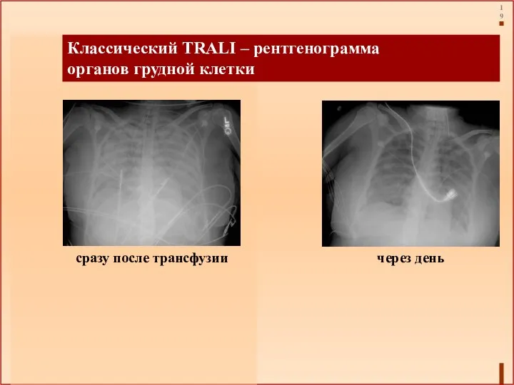 Классический TRALI – рентгенограмма органов грудной клетки сразу после трансфузии через день