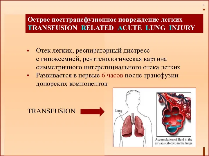 Острое посттрансфузионное повреждение легких TRANSFUSION RELATED ACUTE LUNG INJURY Отек легких,