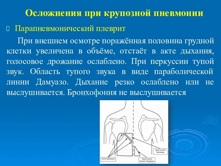 Осложнения при крупозной пневмонии Парапневмонический плеврит При внешнем осмотре поражённая половина