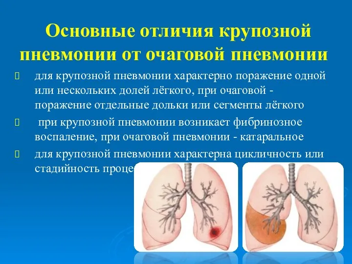 Основные отличия крупозной пневмонии от очаговой пневмонии для крупозной пневмонии характерно