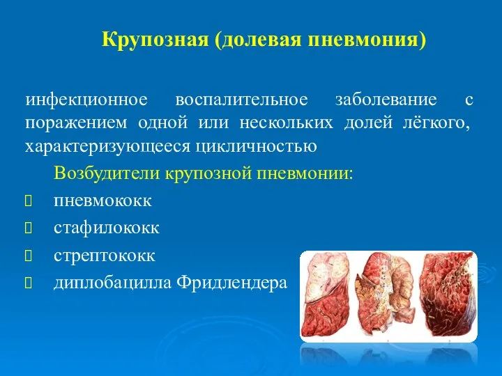 Крупозная (долевая пневмония) инфекционное воспалительное заболевание с поражением одной или нескольких