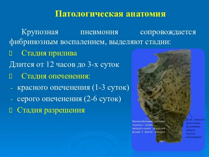 Патологическая анатомия Крупозная пневмония сопровождается фибринозным воспалением, выделяют стадии: Стадия прилива