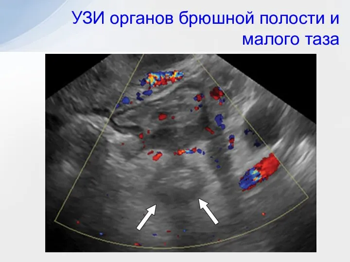 УЗИ органов брюшной полости и малого таза