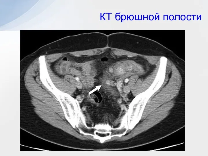 КТ брюшной полости