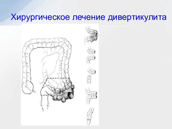 Хирургическое лечение дивертикулита