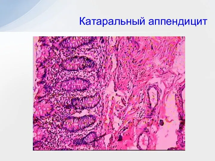 Катаральный аппендицит