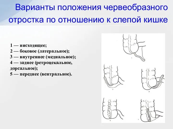 Варианты положения червеобразного отростка по отношению к слепой кишке 1 —