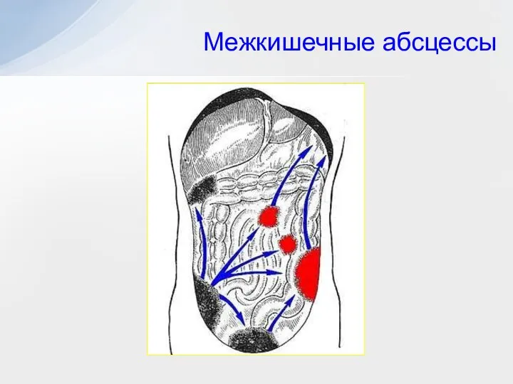 Межкишечные абсцессы