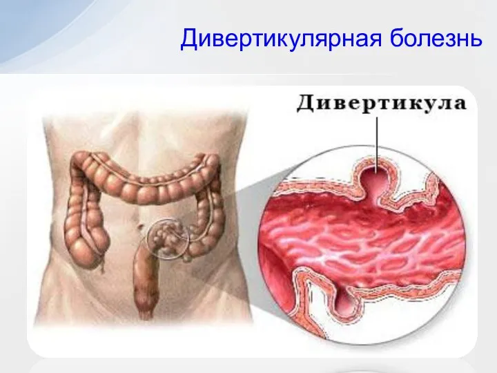 Дивертикулярная болезнь