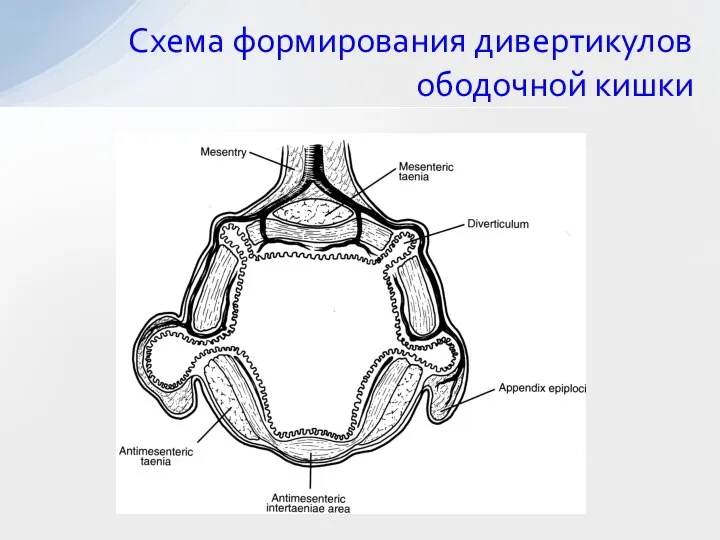 Схема формирования дивертикулов ободочной кишки