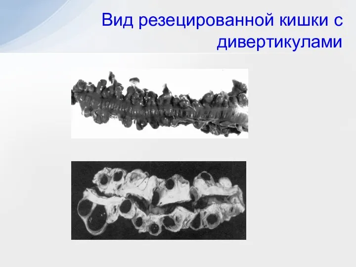 Вид резецированной кишки с дивертикулами