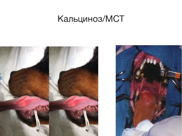 Кальциноз/MCT