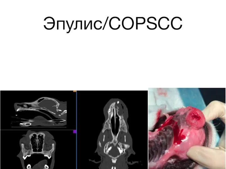 Эпулис/COPSCC