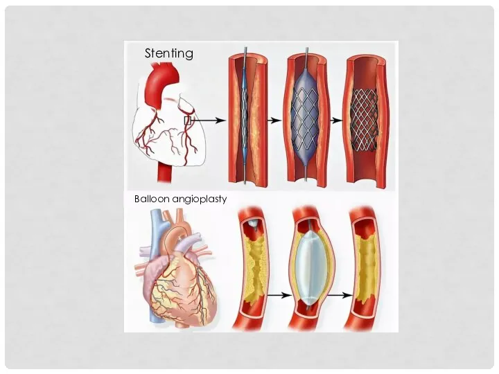 Stenting Balloon angioplasty