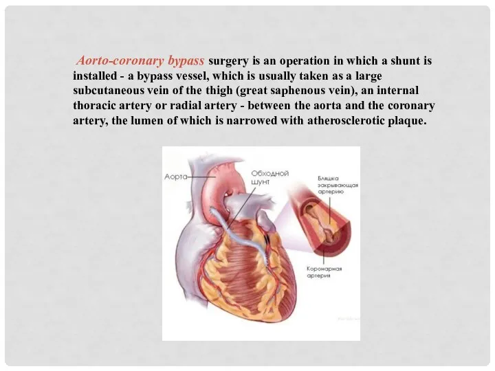 Aorto-coronary bypass surgery is an operation in which a shunt is