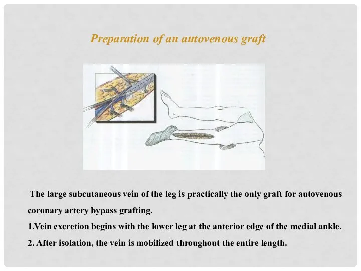 Preparation of an autovenous graft The large subcutaneous vein of the