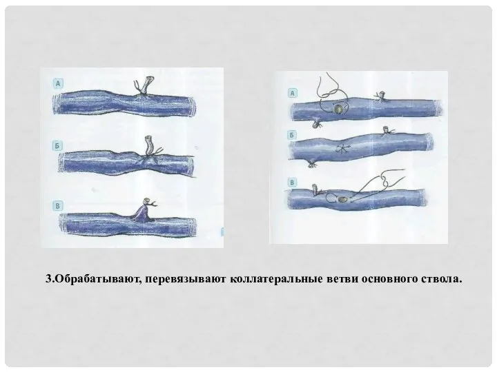 3.Обрабатывают, перевязывают коллатеральные ветви основного ствола.