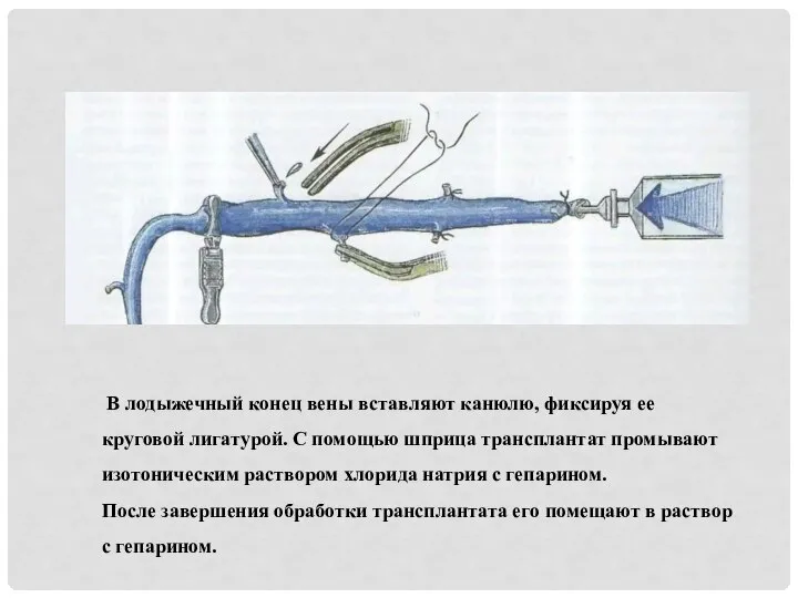 В лодыжечный конец вены вставляют канюлю, фиксируя ее круговой лигатурой. С