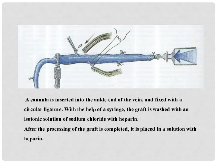 A cannula is inserted into the ankle end of the vein,