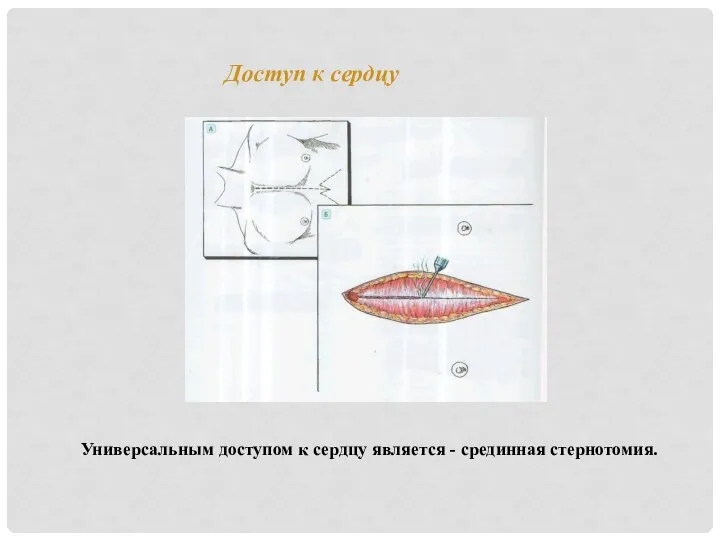 Доступ к сердцу Универсальным доступом к сердцу является - срединная стернотомия.