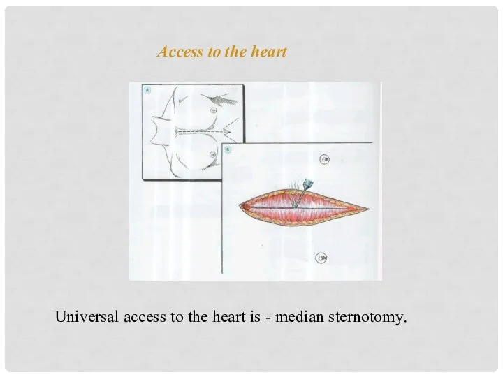 Access to the heart Universal access to the heart is - median sternotomy.