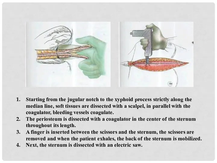 Starting from the jugular notch to the xyphoid process strictly along