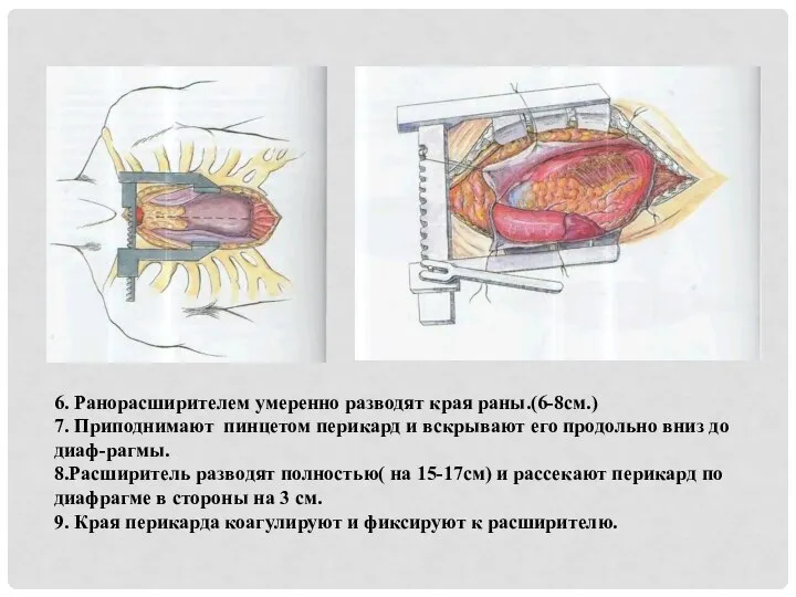 6. Ранорасширителем умеренно разводят края раны.(6-8см.) 7. Приподнимают пинцетом перикард и