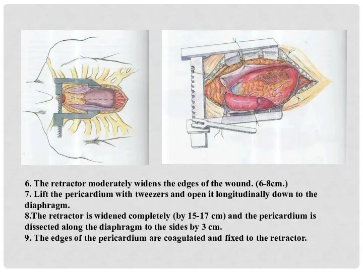 6. The retractor moderately widens the edges of the wound. (6-8cm.)