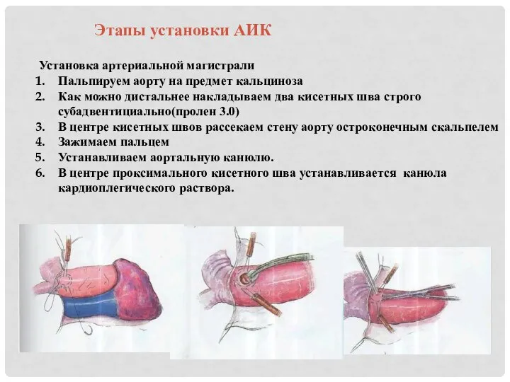 Этапы установки АИК Установка артериальной магистрали Пальпируем аорту на предмет кальциноза