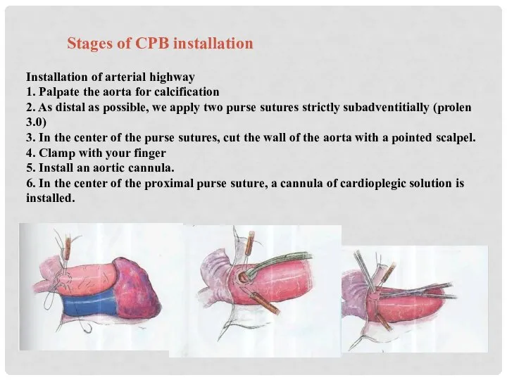 Stages of CPB installation Installation of arterial highway 1. Palpate the