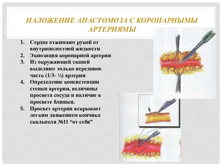 НАЛОЖЕНИЕ АНАСТОМОЗА С КОРОНАРНЫМЫ АРТЕРИЯМЫ Сердце отжимают рукой от внутриполостной жидкости