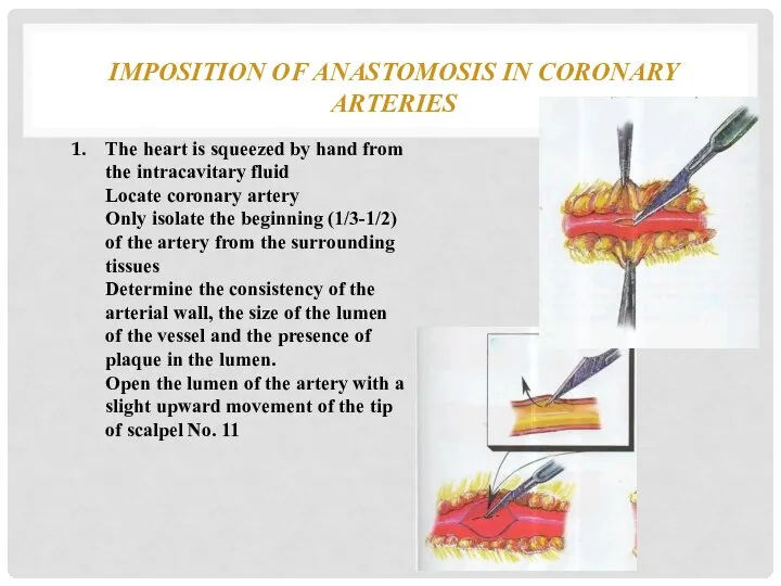 IMPOSITION OF ANASTOMOSIS IN CORONARY ARTERIES The heart is squeezed by