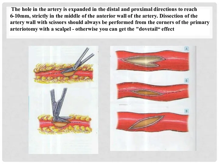 The hole in the artery is expanded in the distal and